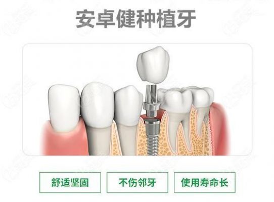 安卓健种植体价格（安卓健植体的优势）-图2
